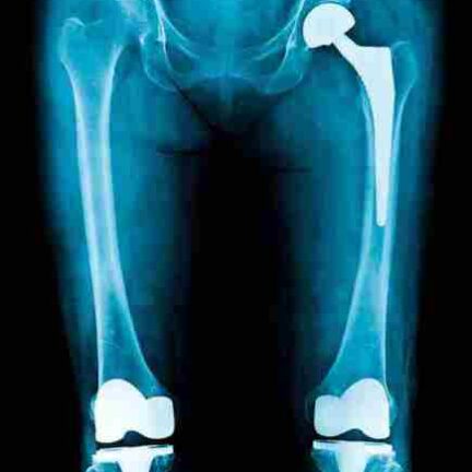 Total Hip Replacement