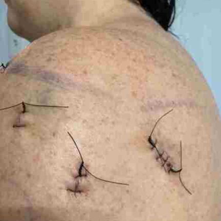 * Rotator Cuff Repair (Shoulder Surgery)