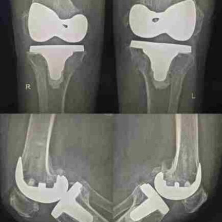 * Total Knee Replacement